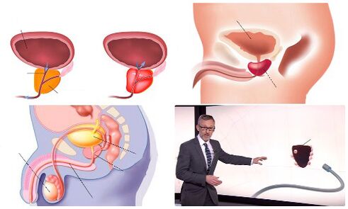 próstata sa e enferma